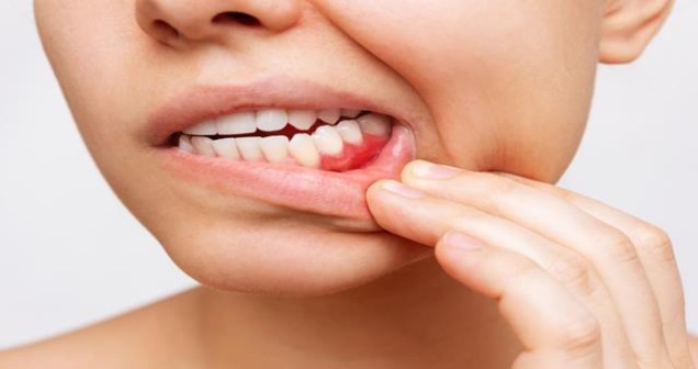 Diş Ağrısı Nasıl Geçer: Evde Uygulanabilecek Doğal Yöntemler