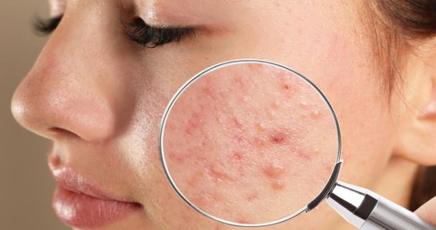 Sivilce Nasıl Geçer: Etkili Çözümler ve Öneriler